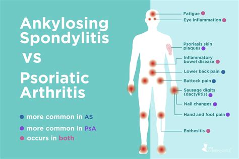 Ankylosing Spondylitis vs. Psoriatic Arthritis: Differences in Symptoms ...