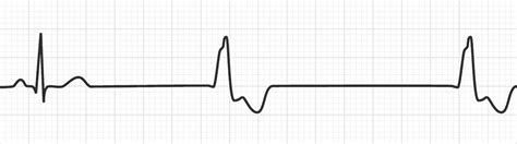 Ventricular Escape Rhythm | Bradyarrhythmias - MedSchool