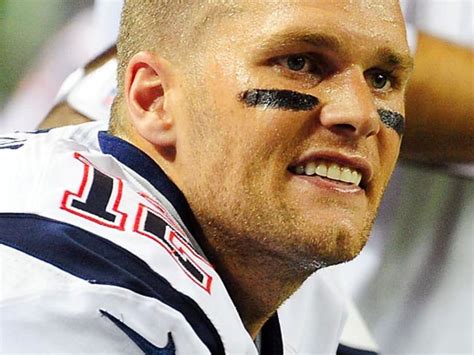 Tom Brady Hair Transplant Scar