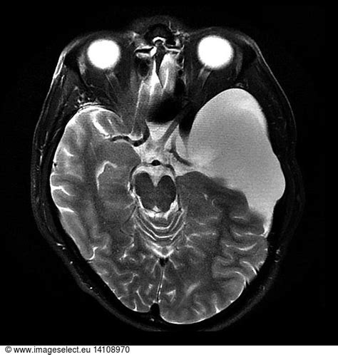 Large Arachnoid Cyst Large Arachnoid Cyst, MRI,abnormal arachnoid ...