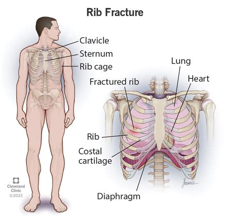 Rib Fracture:Symptoms, Healing Tips & Treatment – Streaming Medics