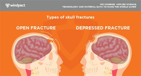 Types Of Skull Fractures