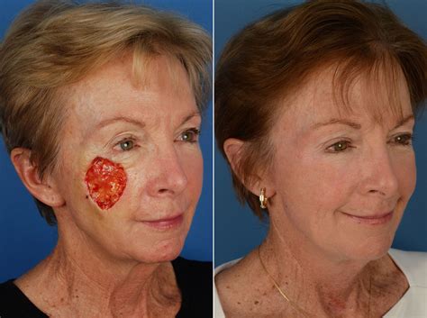 Skin Cancer Reconstruction Photos | Naples, FL | Patient 12033