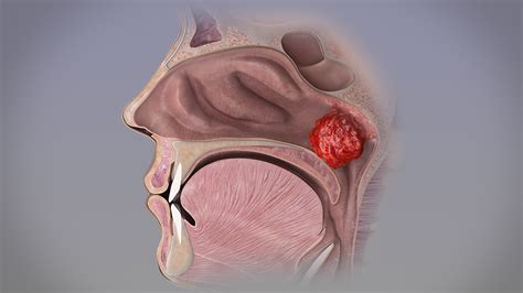 Adenoidectomy procedure to remove adenoid gland | Lymphatic & Endocrine ...