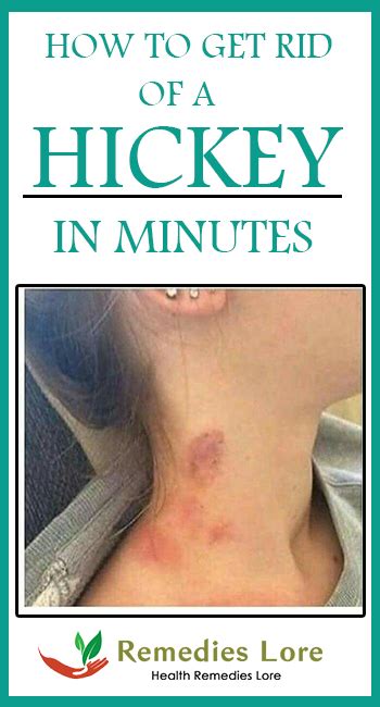 How to Get Rid of Hickey in Minutes - 10 DIY Methods - Remedies Lore