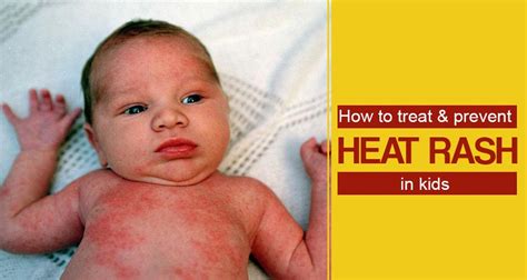 Home Remedies for Heat Rashes in Kids | Prevention and Treatment