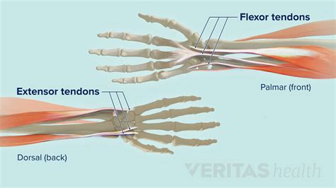 Wrist Tendonitis: An Overview | Sports-health