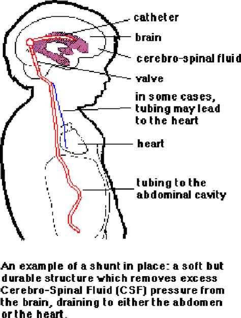 What is a shunt? - Mid-West Spina Bifida and Hydrocephalus Association