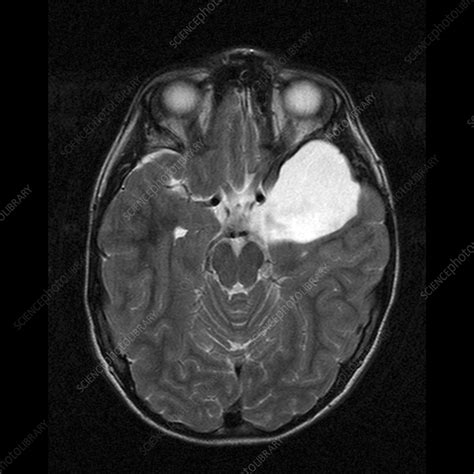 Arachnoid Cyst, MRI scan - Stock Image M130/0944 - Science Photo Library