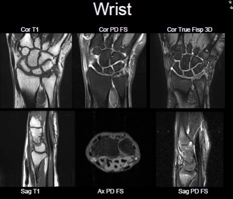 Ulnar Collateral Ligament Wrist Mri