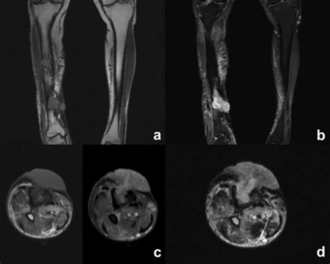 Squamous cell carcinoma of the right leg. (a) Cor T1-w shows deformity ...