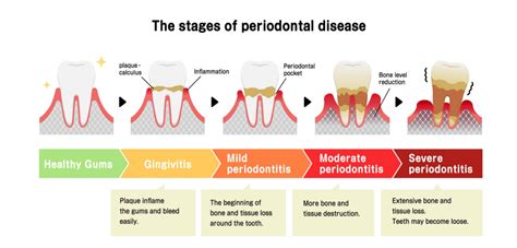 Periodontal (gum) Therapy Mississauga | Lakeshore Dental Center