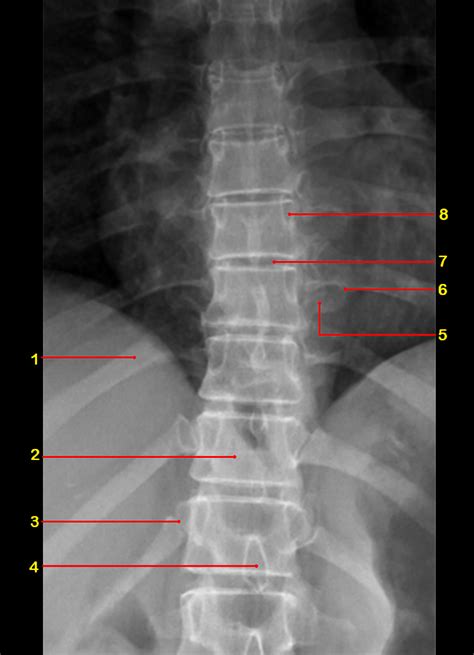 Lumbar Spine Xray Anatomy