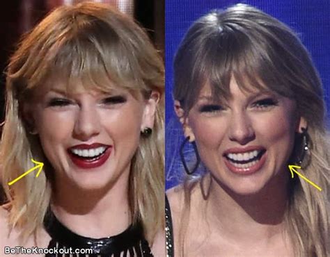 Taylor Swift Eyelid Surgery