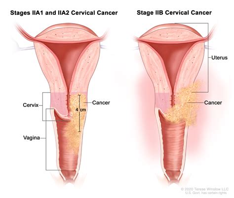 Cervical Cancer Treatment (PDQ®) - NCI