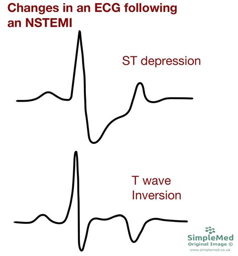 Nstemi Ecg Examples