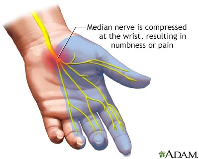 Carpal Tunnel Syndrome Symptoms, Doctors, Treatments, Advances & More ...