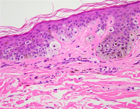 Compound Nevus Histology