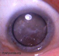 mature cataract that is entering the hypermature stage. EyeRounds.org: Online Ophthalmic Atlas