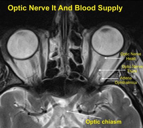 What is NAION and Is Eyesight Loss Irreversible? Research and Practice