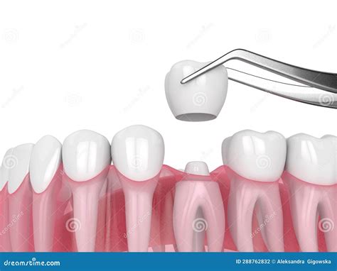 3d Render of Crown Replacement on Reshaped Tooth Stock Illustration ...