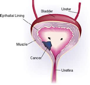 Bladder Pain – Medical Symptoms Guide