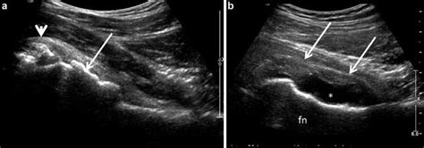 Ultrasound of the Hip | Musculoskeletal Key