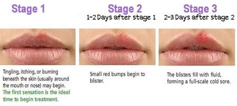 Cold Sore Stages, Pictures, Timeline, Early, Contagious, Healing, Scab ...