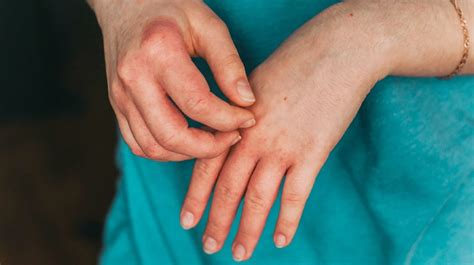 7 Types of Eczema: Symptoms, Causes, and Pictures