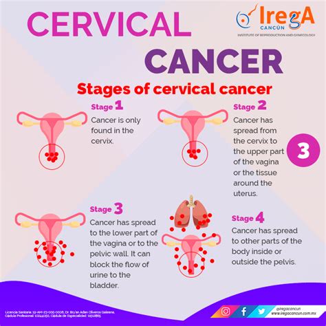 Cervical Cancer