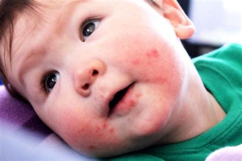 Teething Rash: Symptoms, Treatment & Remedies for Babies