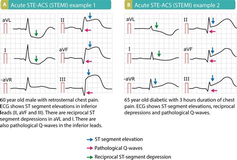 STEMI (ST Elevation Myocardial Infarction): diagnosis, criteria, ECG & management – ECG learning