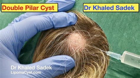 Double Pilar Cyst Removal. Part 2. Live. DR Khaled Sadek - Pimple ...