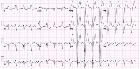 Right Vs Left Bundle Branch Block Ecg | Porn Sex Picture