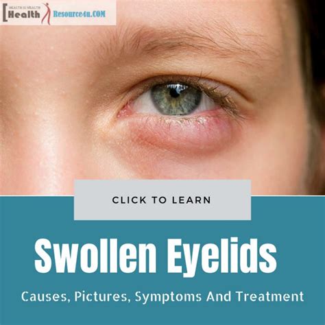 Makeup Causes Swollen Eyelids - Mugeek Vidalondon