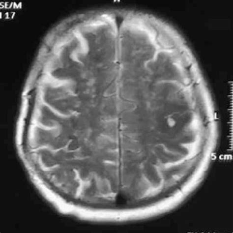 MRI brain axial view T2-weighted image showing left central sulcus ...