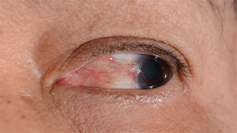 Pterygium Removal in Queens NY