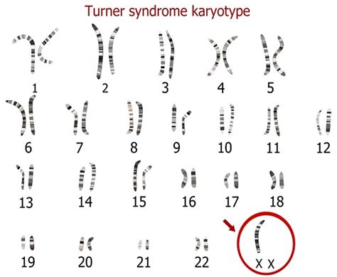 Turner Syndrome - Causes, Symptoms, Life Expectancy, Treatment