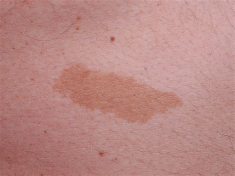 Birthmark causes, types of birthmarks and how to get rid of birthmarks