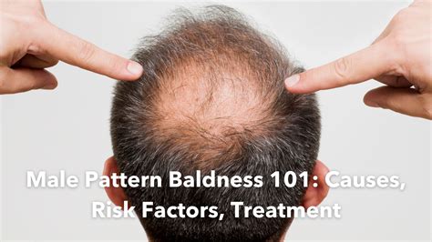 Male Pattern Baldness (Androgenic Alopecia): Stages, Treatment | atelier-yuwa.ciao.jp