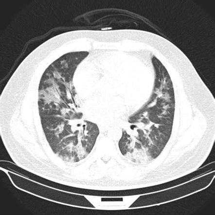 Organizing Pneumonia Ct Scan