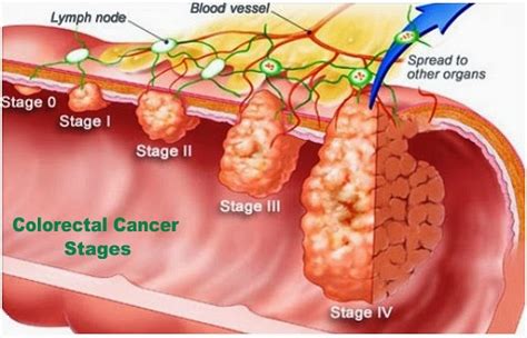 Know more colorectal colon cancer- Southlake General Surgery