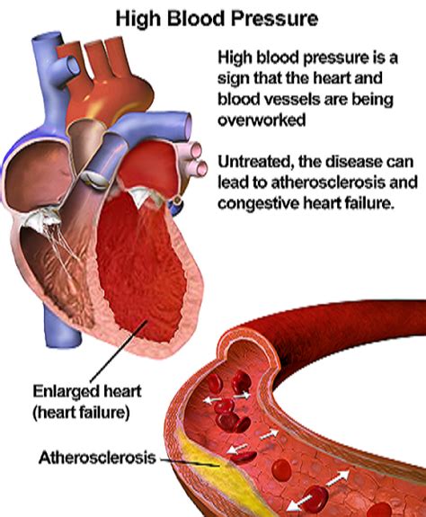 High Blood Pressure: Symptoms, Causes & Remedies | Study.com