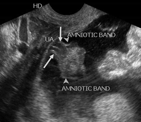 Amniotic band syndrome causes, symptoms, diagnosis & treatment