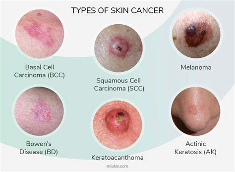 Skin Cancer Pictures | Most Common Skin Cancer Types with Images