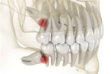 Why Do Wisdom Teeth Cause Pain? | Monte Vista Dental Group - Blog