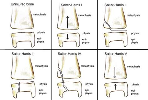 Typical Fractures Seen in Children: Slideshow