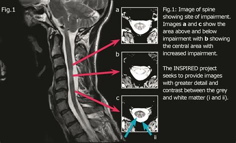 INSPIRED: A quantifiable multi-centre spinal cord neuro-imaging project