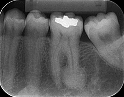 Periapical radiograph showing radiopaque halo around the root of tooth #36 | Download Scientific ...