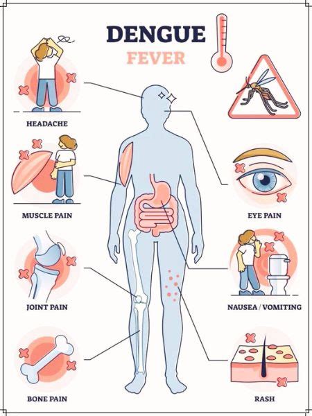 Dengue Fever - Symptoms, Causes and Treatment